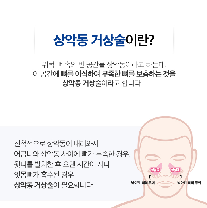 사상맥치과 상악동 거상술