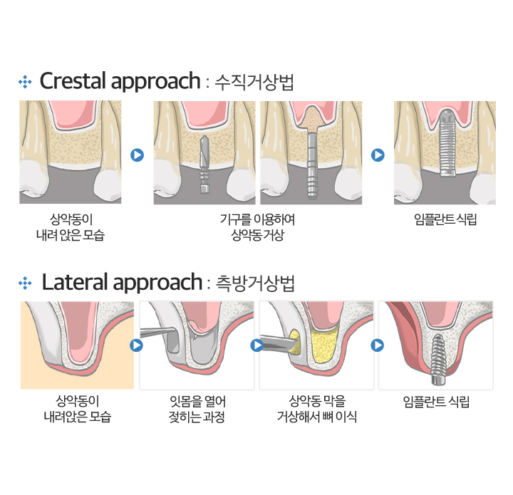 사상맥치과 상악동 거상술