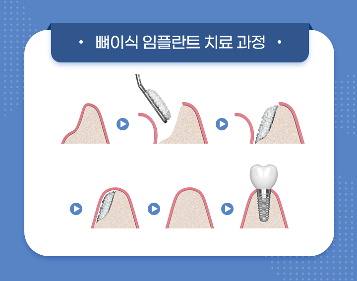 사상맥치과 뼈이식 수술