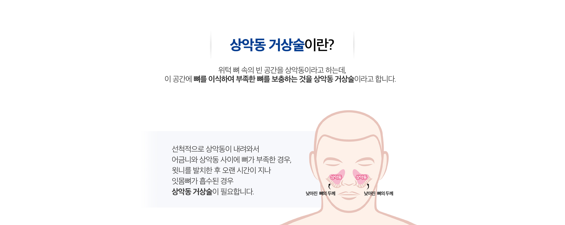 사상맥치과 상악동 거상술