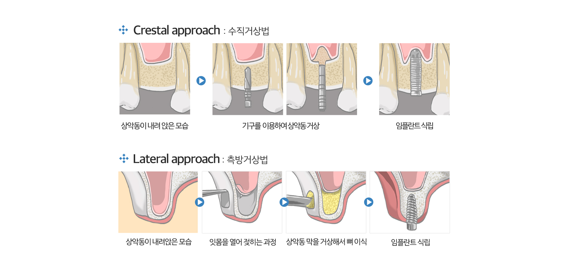 사상맥치과 상악동 거상술