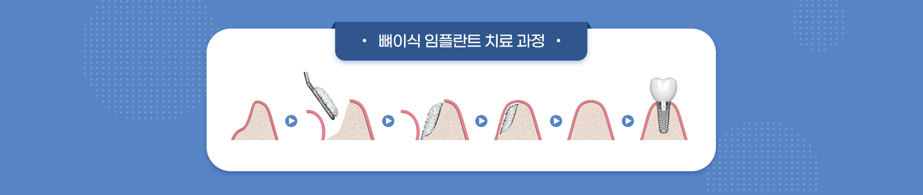 사상맥치과 뼈이식 수술