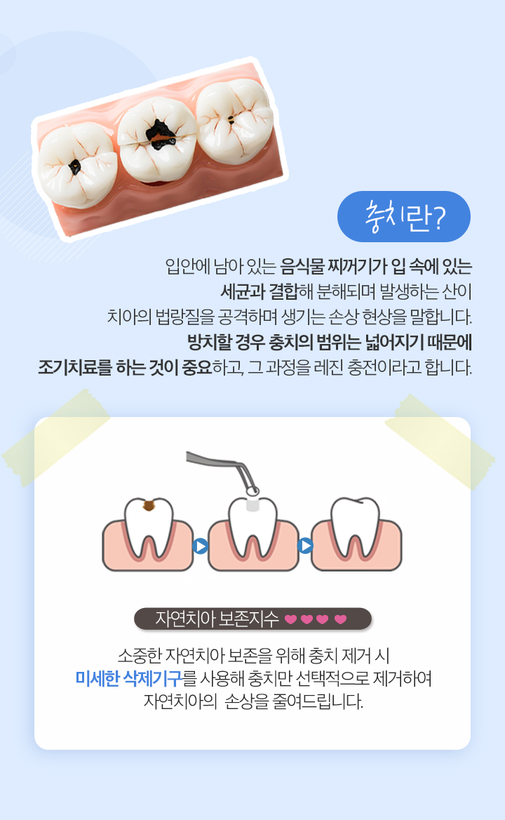 사상맥치과 레진충전