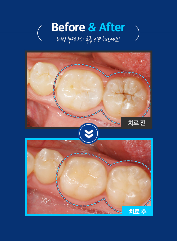 사상맥치과 레진충전