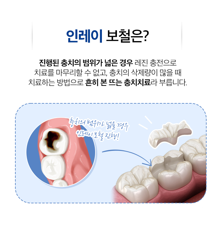 사상맥치과 인레이 보철