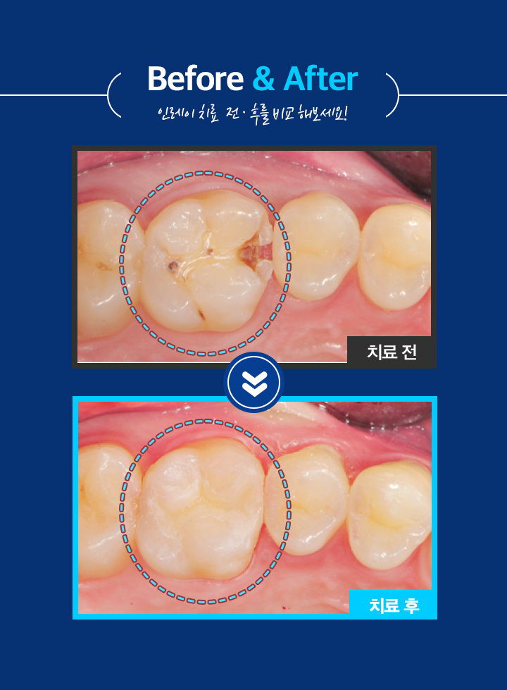 사상맥치과 인레이 보철