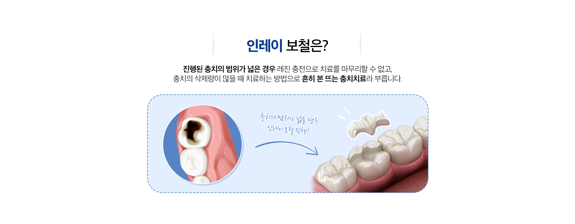 사상맥치과 인레이 보철