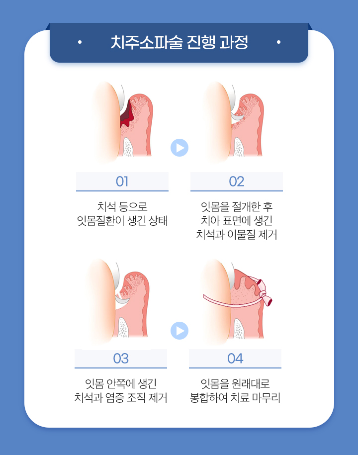 사상맥치과 치주소파술