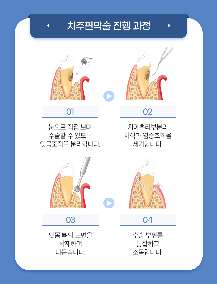 사상맥치과 치주판막술