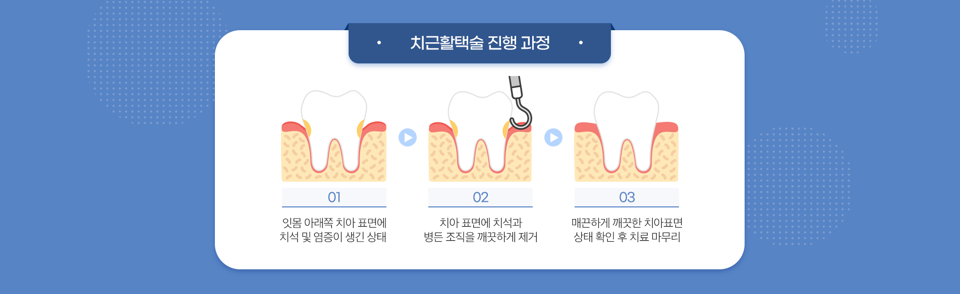 사상맥치과 치근활택술