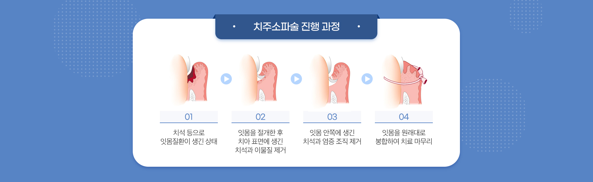 사상맥치과 치주소파술