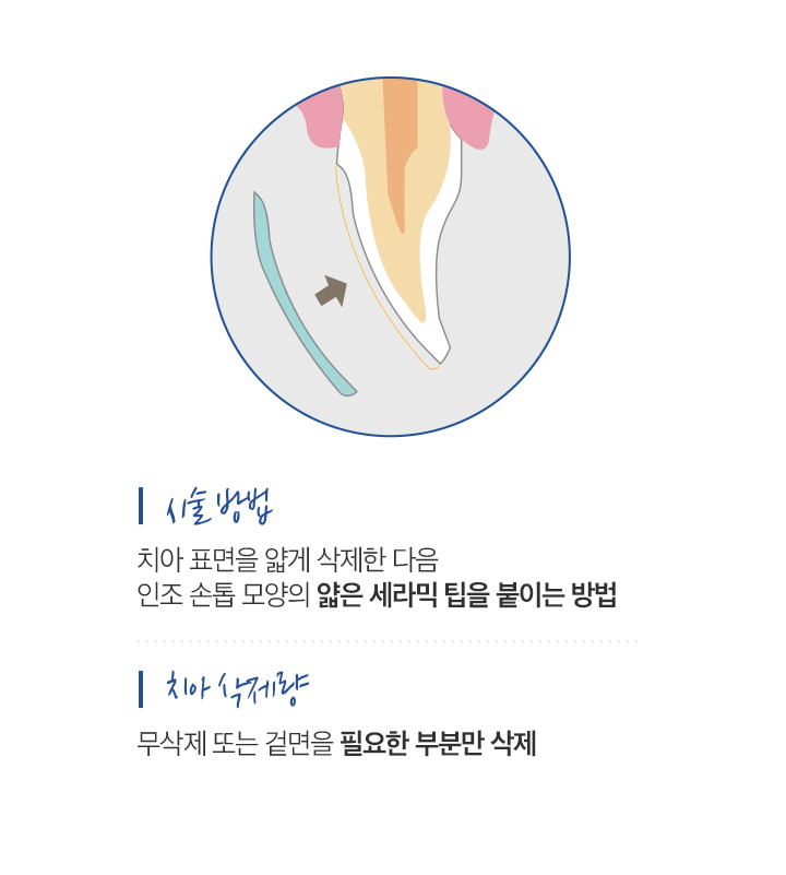 사상맥치과 라미네이트