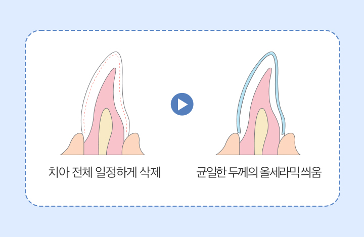 사상맥치과 울세라믹