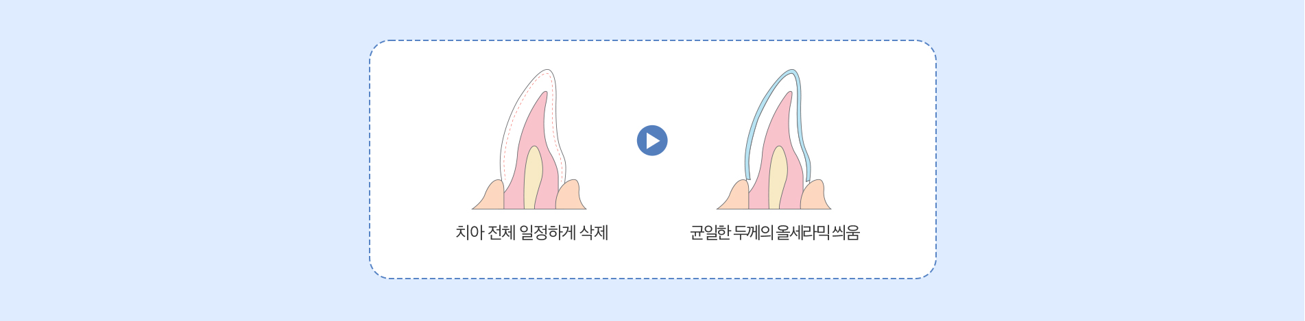 사상맥치과 울세라믹