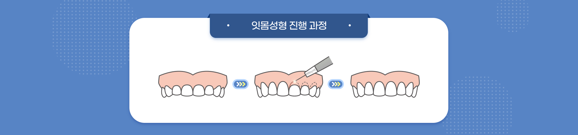 사상맥치과 잇몸성형