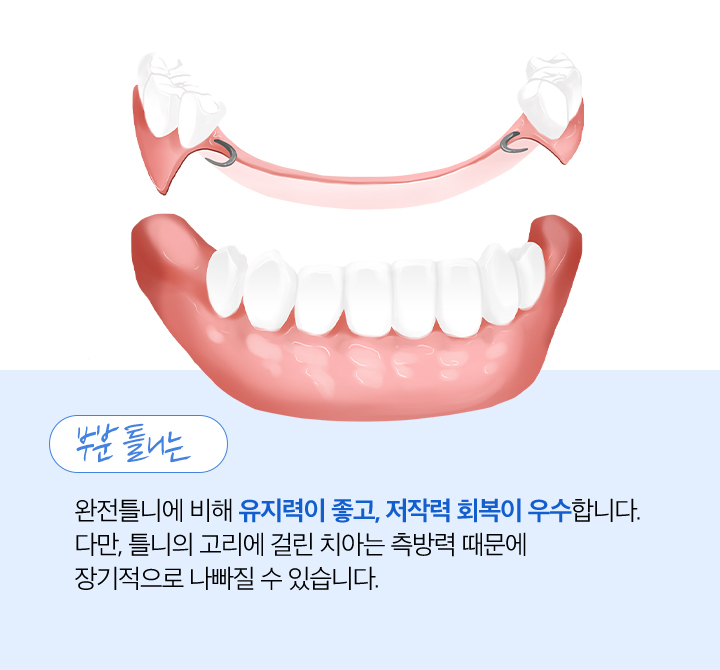 사상맥치과 부분틀니