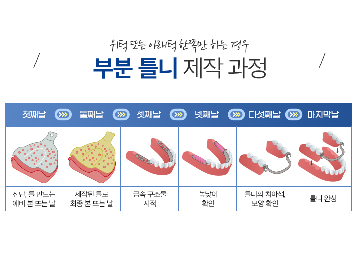 사상맥치과 부분틀니