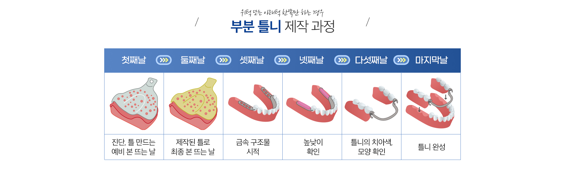 사상맥치과 부분틀니