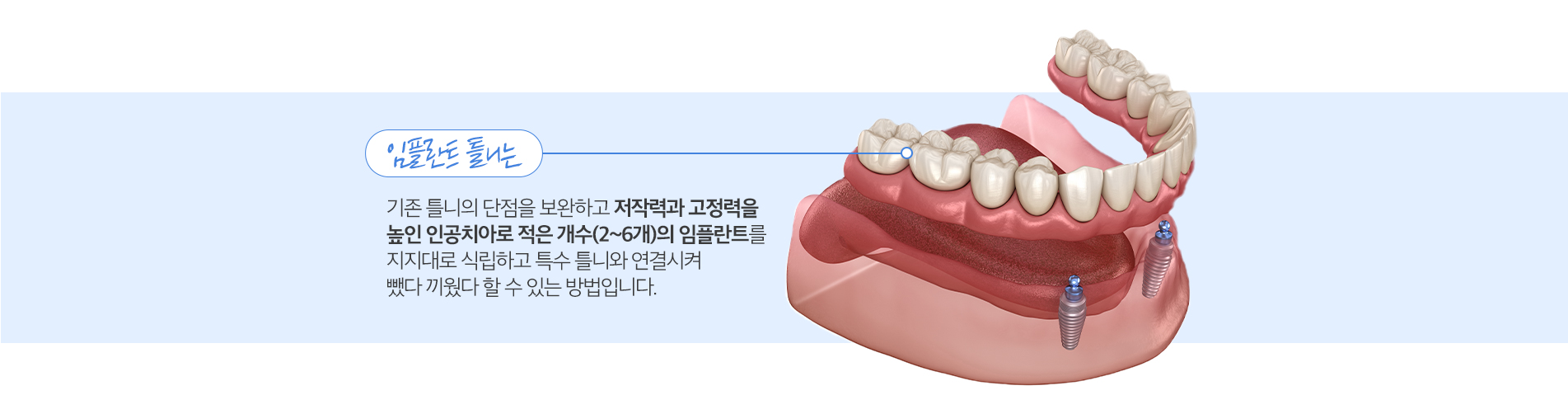 사상맥치과 임플란트 틀니